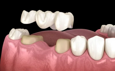 Festsitzender Zahnersatz in Bonn