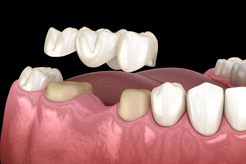 Festsitzender Zahnersatz bei Rogler Zahnmedizin in Bonn