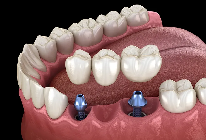 Implantate zum Ersatz mehrerer fehlender Zaehne-1 Implantate zum Ersatz mehrerer fehlender Zähne