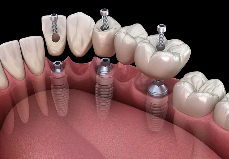 Implantate zum Ersatz mehrerer fehlender Zaehne-2 Implantate zum Ersatz mehrerer fehlender Zähne